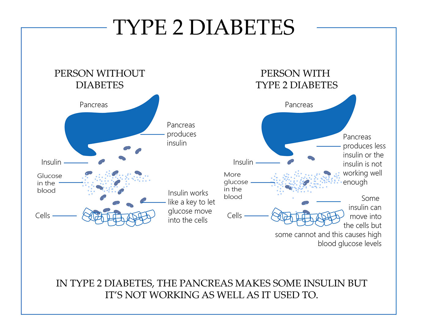 Type 2 diabetes