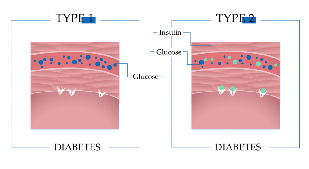 Type 1 and  type 2 diabetes symptoms