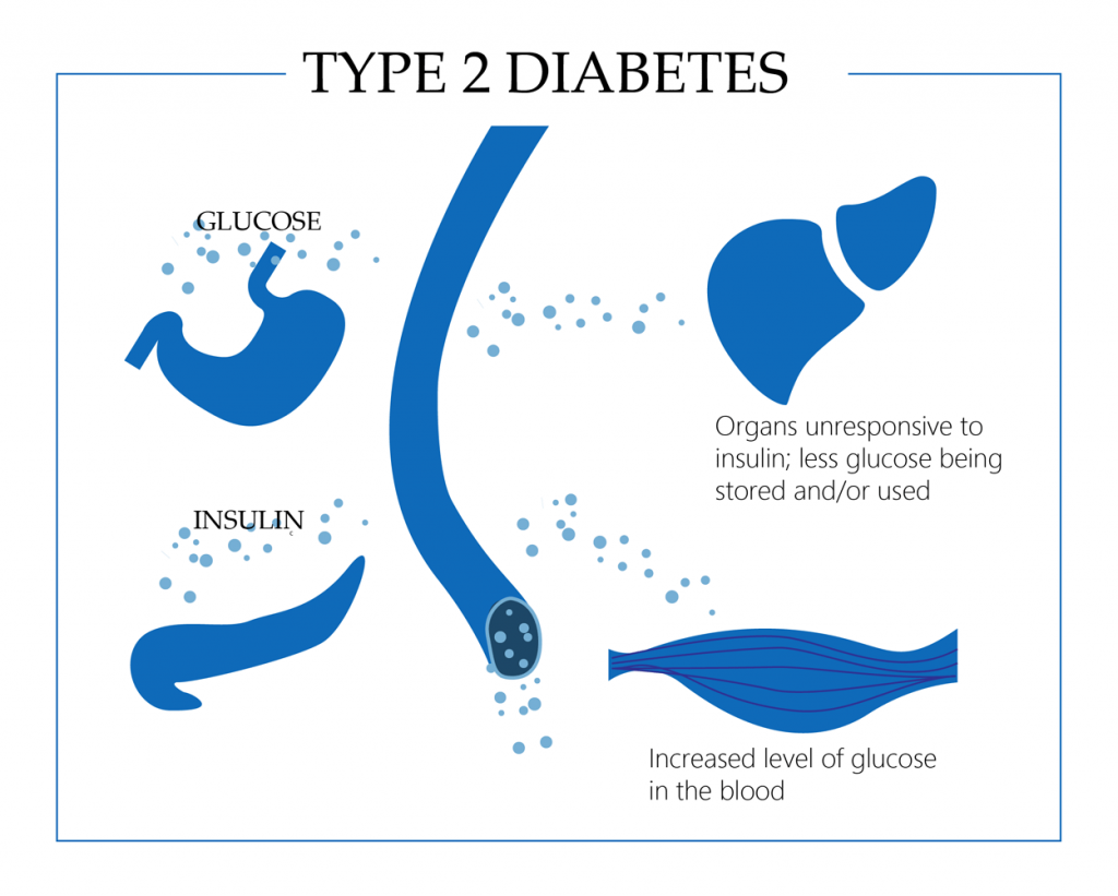 Type 2 diabetes