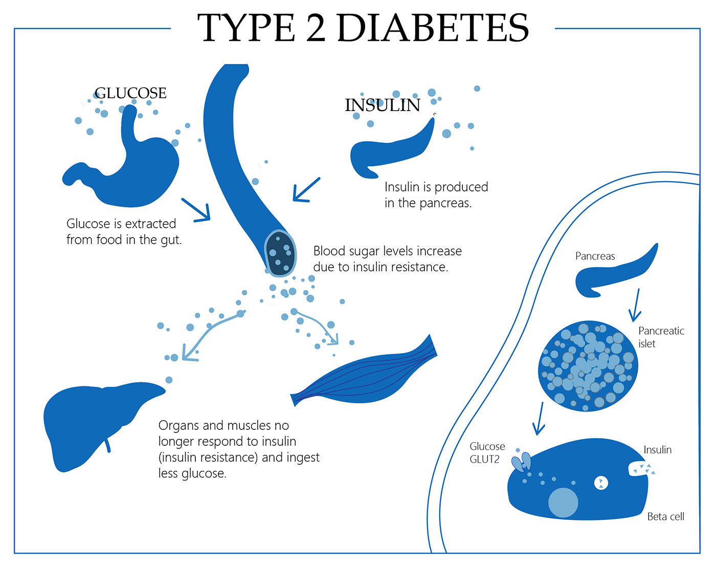 Type 2 Diabetes Type 2 Diabetes