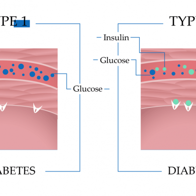 Type 1 and type 2 diabetes symptoms